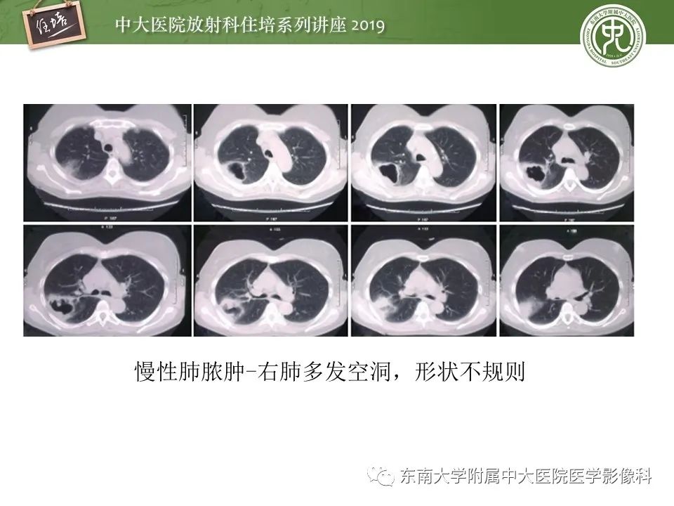 【PPT】肺空洞病变影像诊断及鉴别