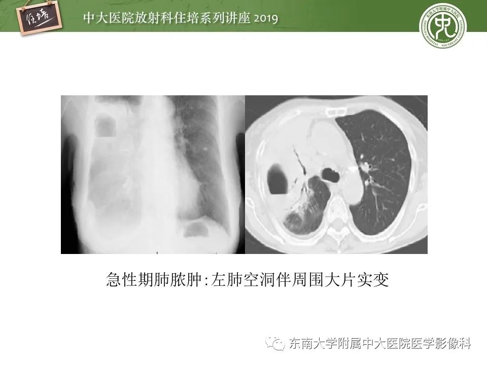 【PPT】肺空洞病变影像诊断及鉴别