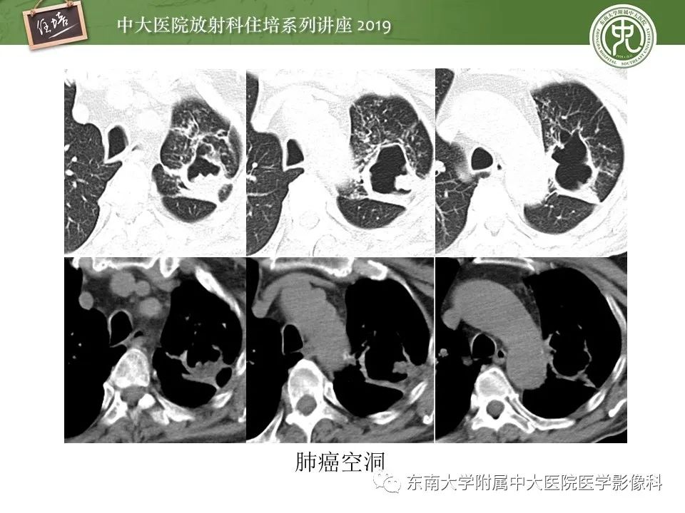 【PPT】肺空洞病变影像诊断及鉴别
