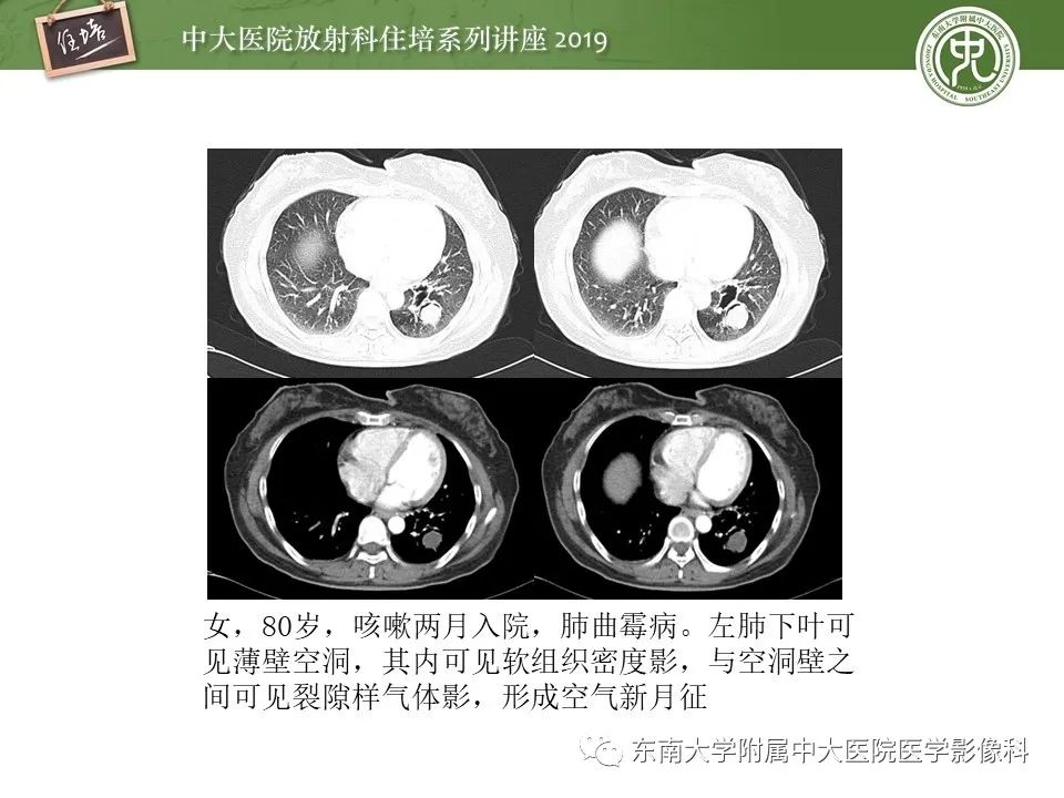 【PPT】肺空洞病变影像诊断及鉴别