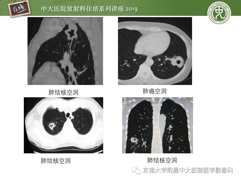 【PPT】肺空洞病变影像诊断及鉴别