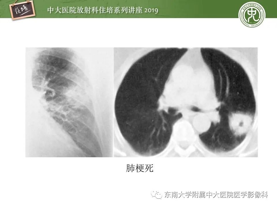 【PPT】肺空洞病变影像诊断及鉴别