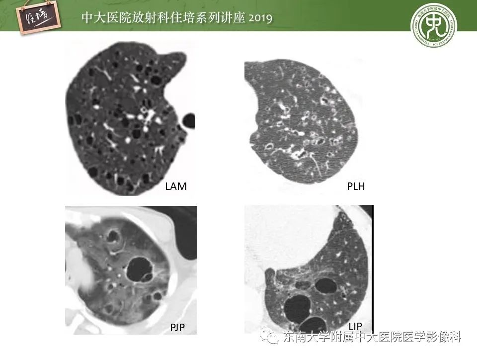 【PPT】肺空洞病变影像诊断及鉴别