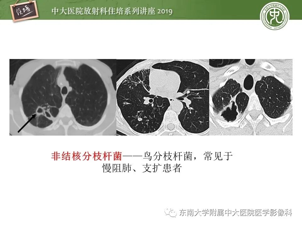 【PPT】肺空洞病变影像诊断及鉴别