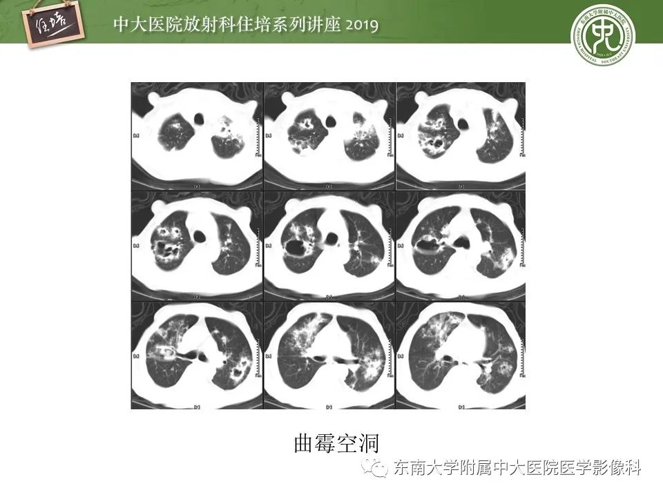 【PPT】肺空洞病变影像诊断及鉴别