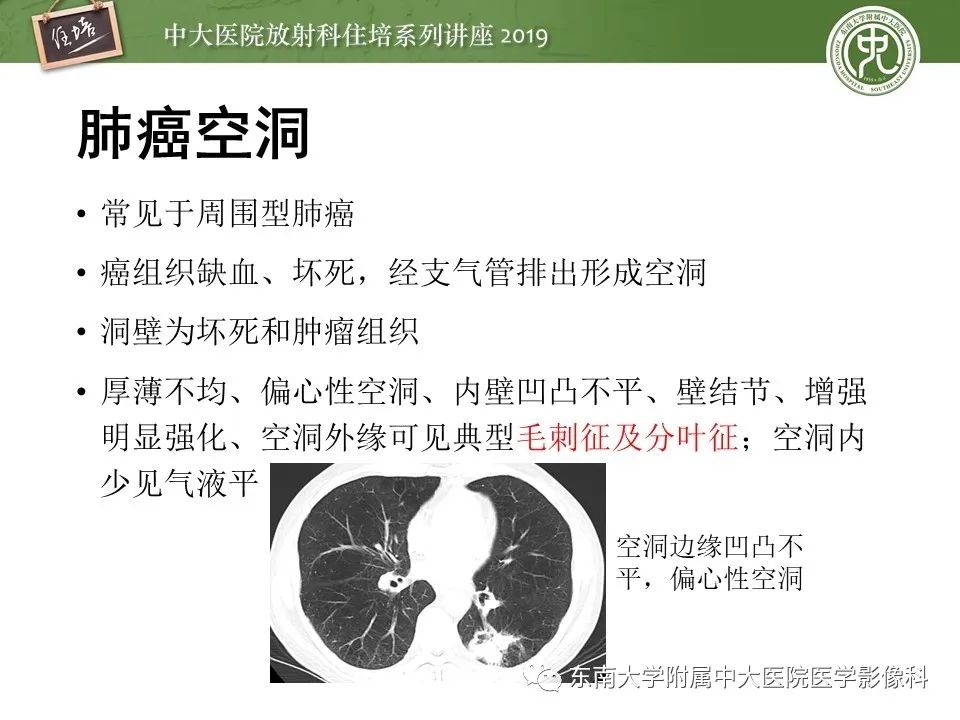 【PPT】肺空洞病变影像诊断及鉴别