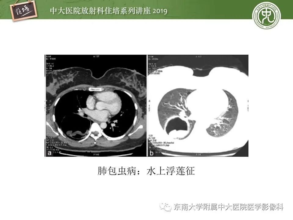 【PPT】肺空洞病变影像诊断及鉴别