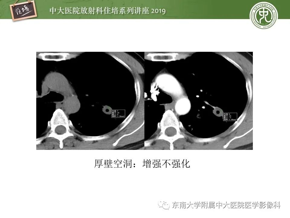 【PPT】肺空洞病变影像诊断及鉴别