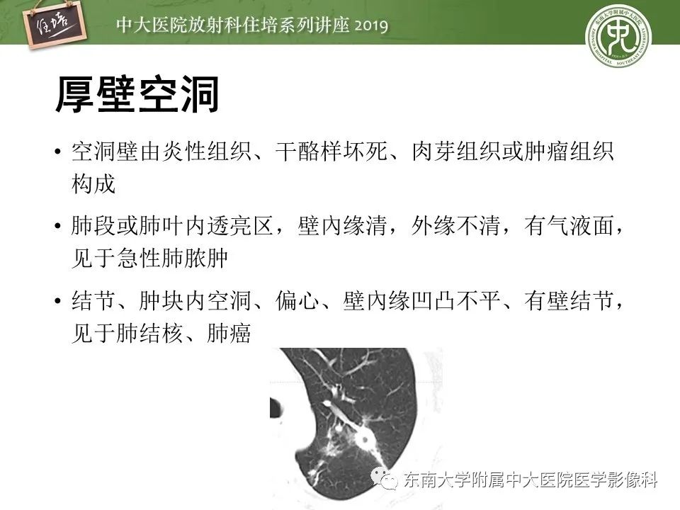 【PPT】肺空洞病变影像诊断及鉴别