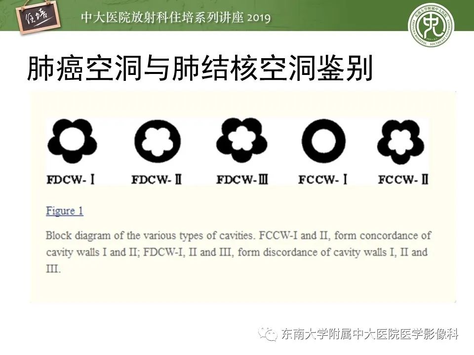 【PPT】肺空洞病变影像诊断及鉴别