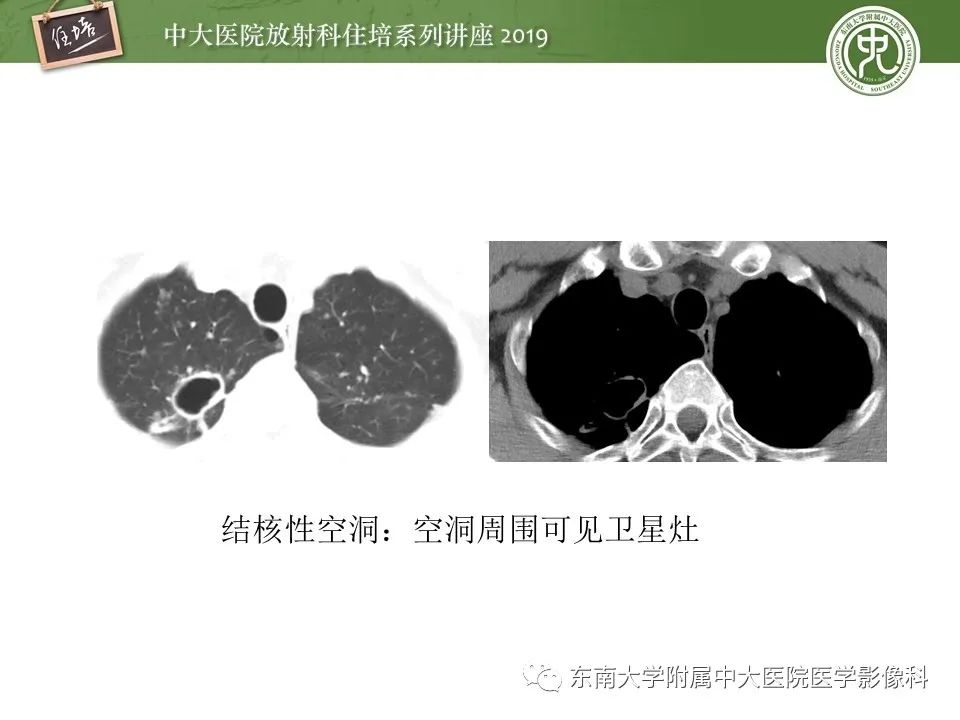 【PPT】肺空洞病变影像诊断及鉴别