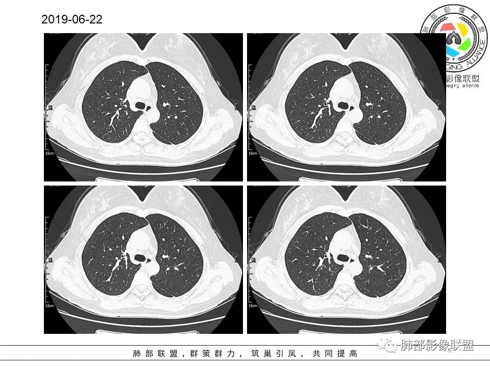 【病例】左肺上叶腺癌1例CT影像讨论