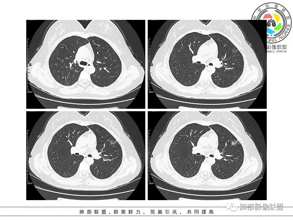 【病例】左肺上叶腺癌1例CT影像讨论