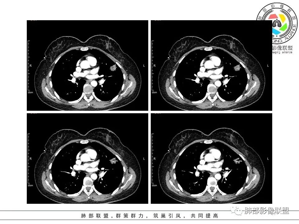 【病例】左肺上叶腺癌1例CT影像讨论