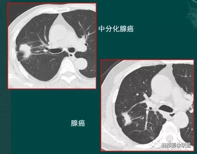 【病例】左肺上叶腺癌1例CT影像讨论