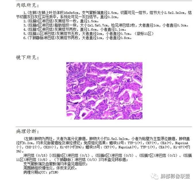 【病例】左肺上叶腺癌1例CT影像讨论
