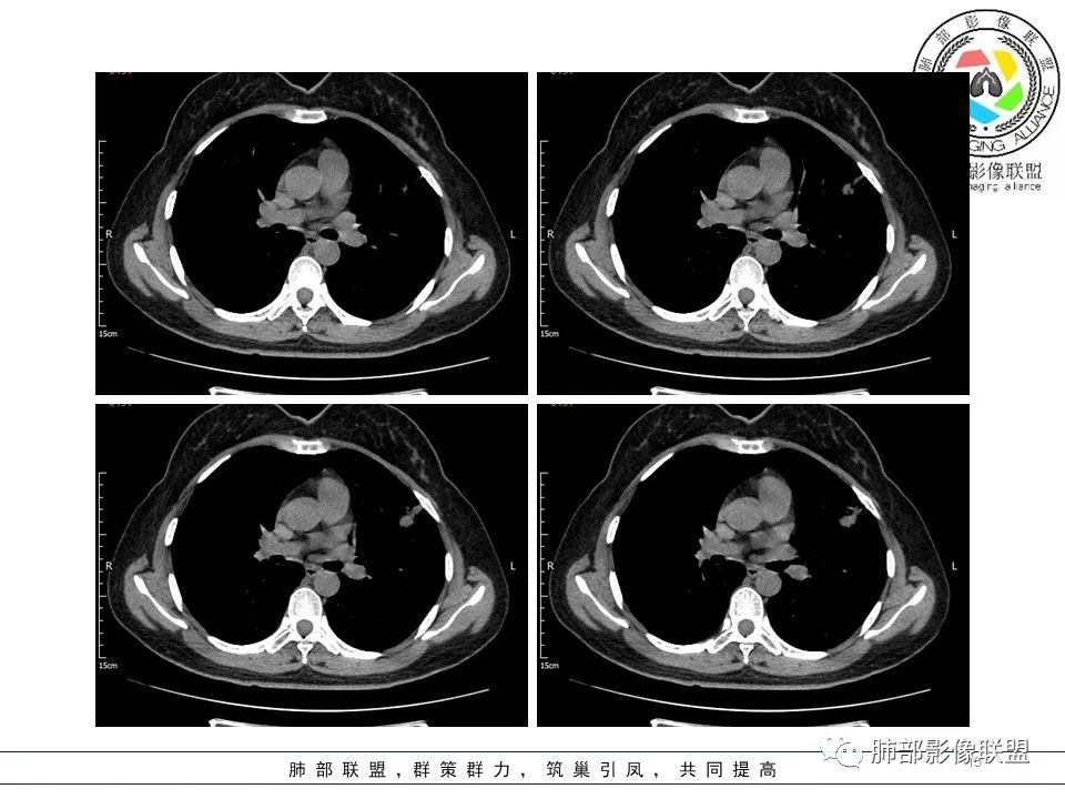 【病例】左肺上叶腺癌1例CT影像讨论