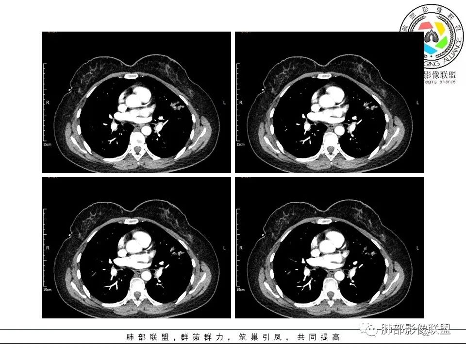 【病例】左肺上叶腺癌1例CT影像讨论