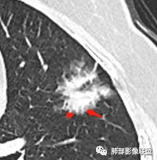 【病例】左肺上叶腺癌1例CT影像讨论