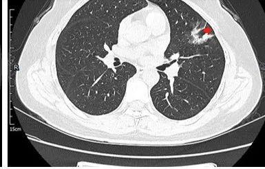 【病例】左肺上叶腺癌1例CT影像讨论