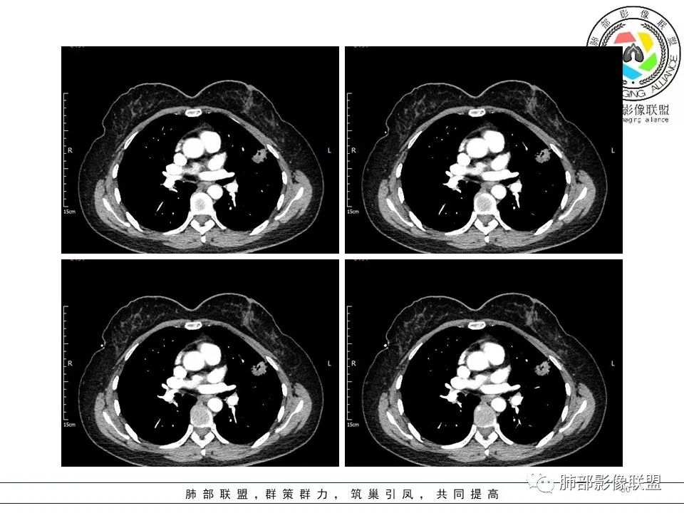 【病例】左肺上叶腺癌1例CT影像讨论