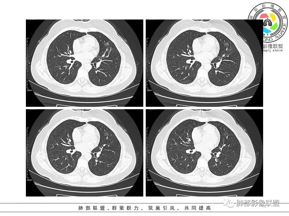 【病例】左肺上叶腺癌1例CT影像讨论