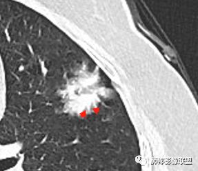 【病例】左肺上叶腺癌1例CT影像讨论