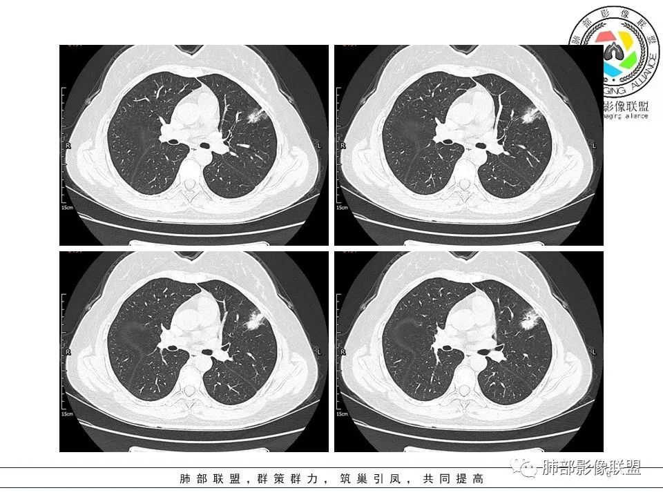 【病例】左肺上叶腺癌1例CT影像讨论