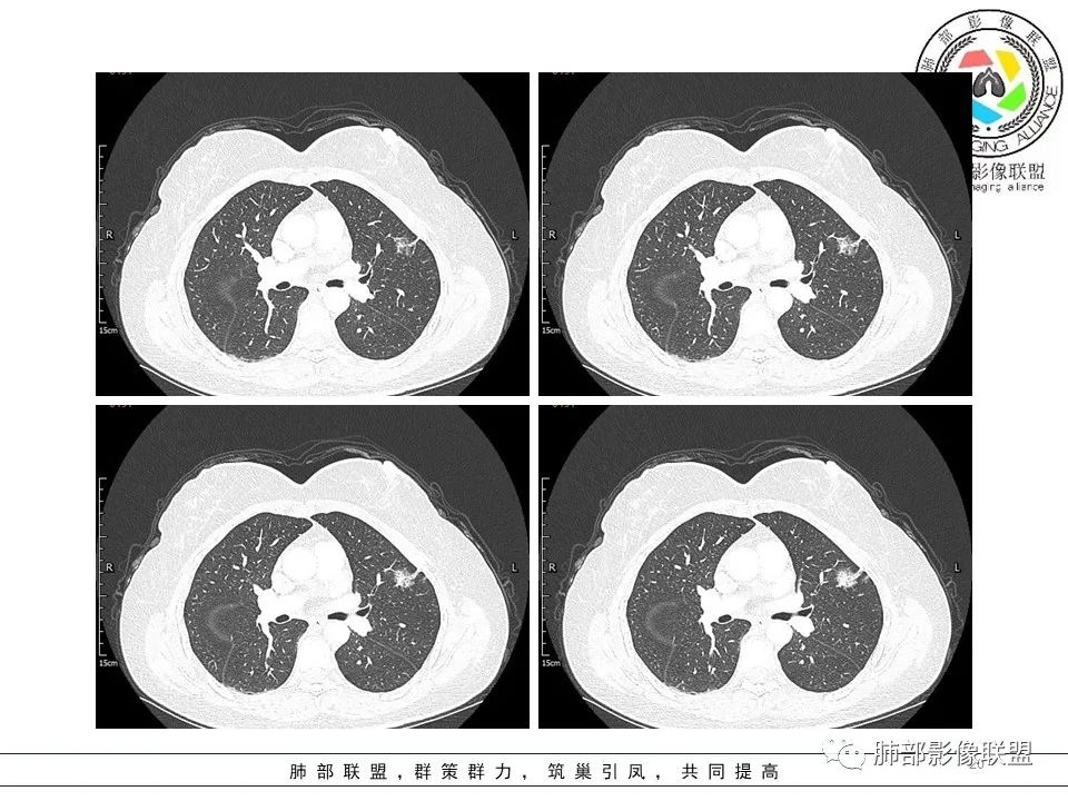 【病例】左肺上叶腺癌1例CT影像讨论