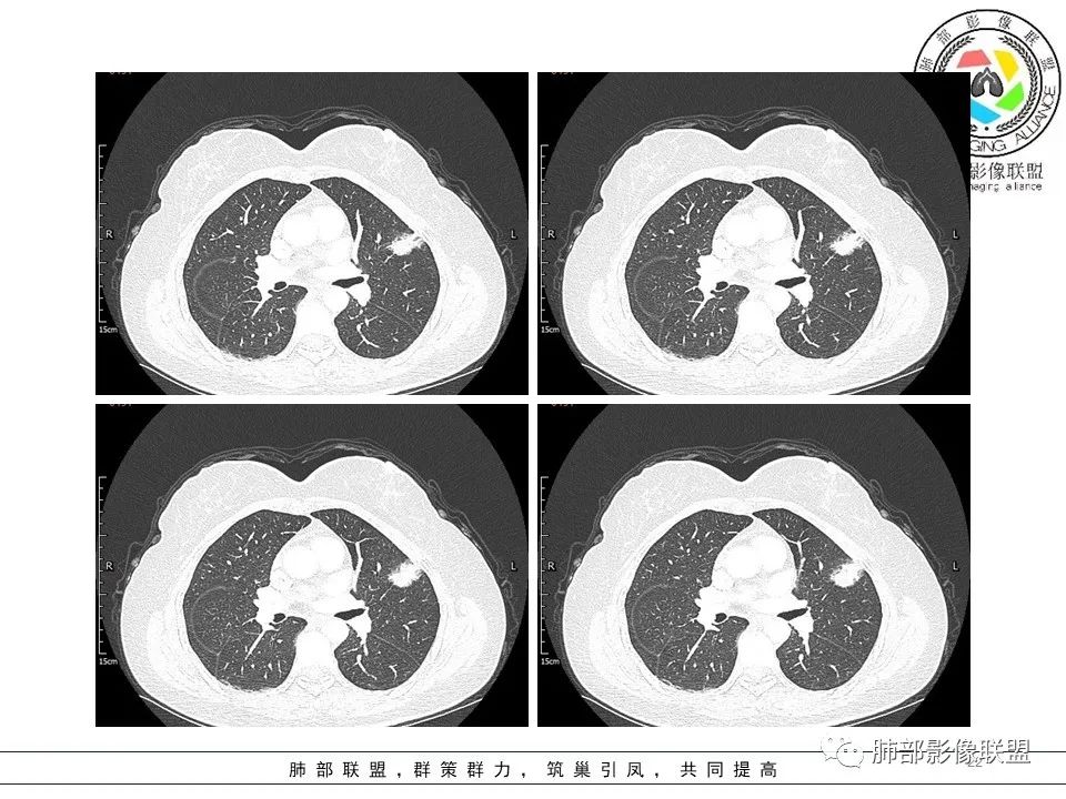 【病例】左肺上叶腺癌1例CT影像讨论