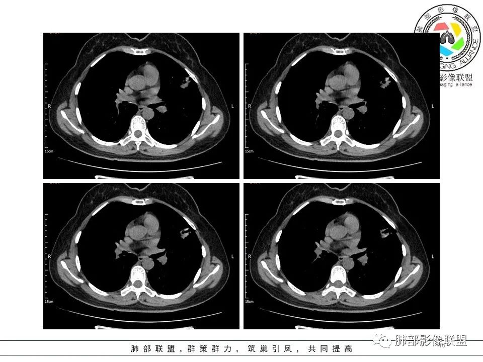 【病例】左肺上叶腺癌1例CT影像讨论