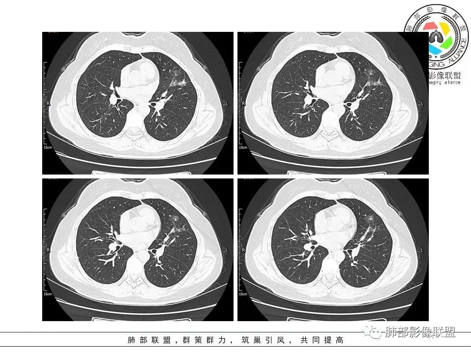 【病例】左肺上叶腺癌1例CT影像讨论