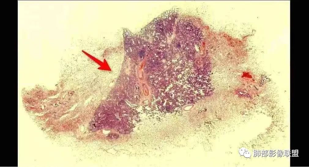 【病例】左肺上叶腺癌1例CT影像讨论