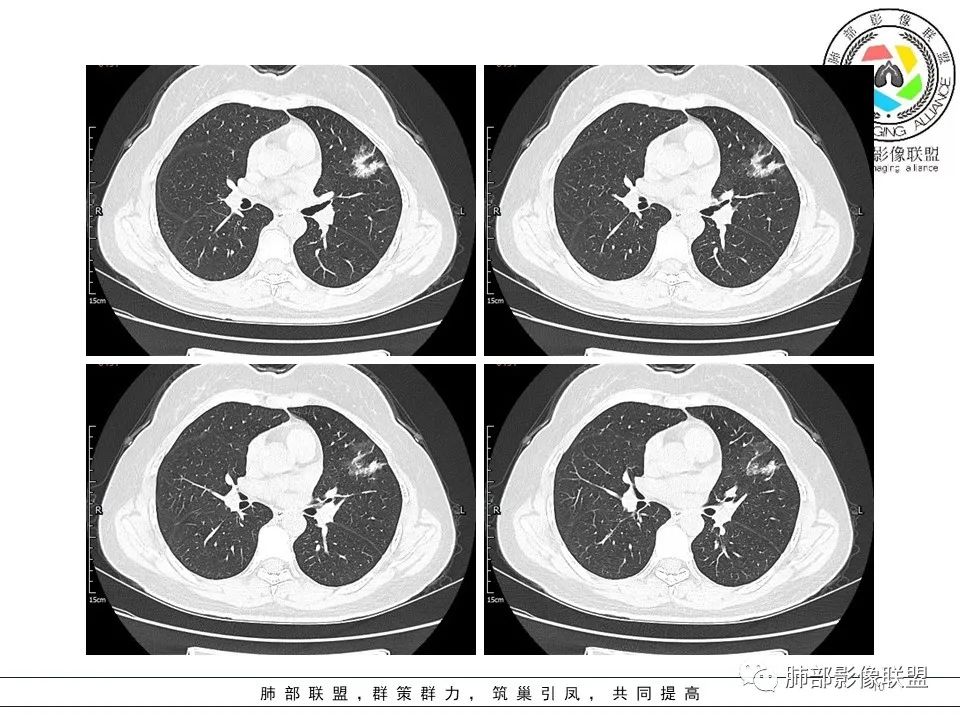 【病例】左肺上叶腺癌1例CT影像讨论
