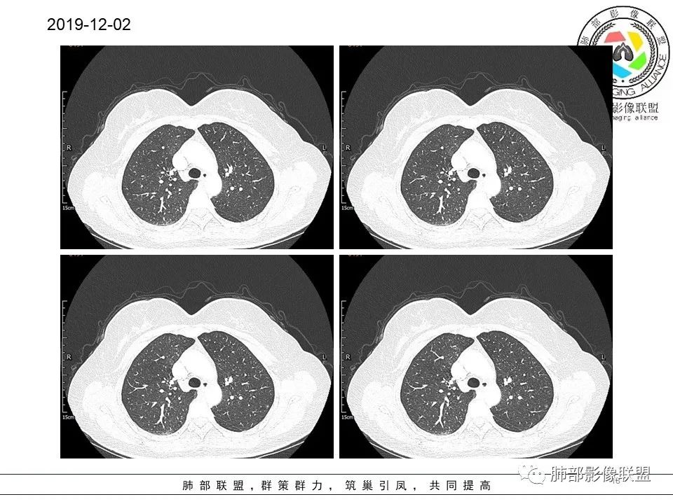 【病例】左肺上叶腺癌1例CT影像讨论