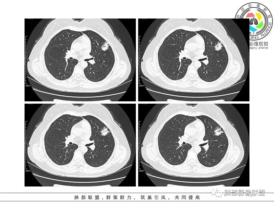 【病例】左肺上叶腺癌1例CT影像讨论