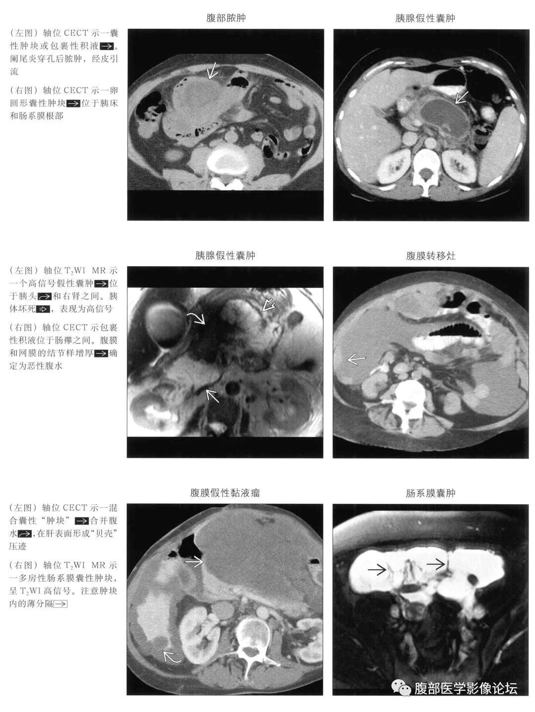 肠系膜或网膜囊性肿块疾病谱