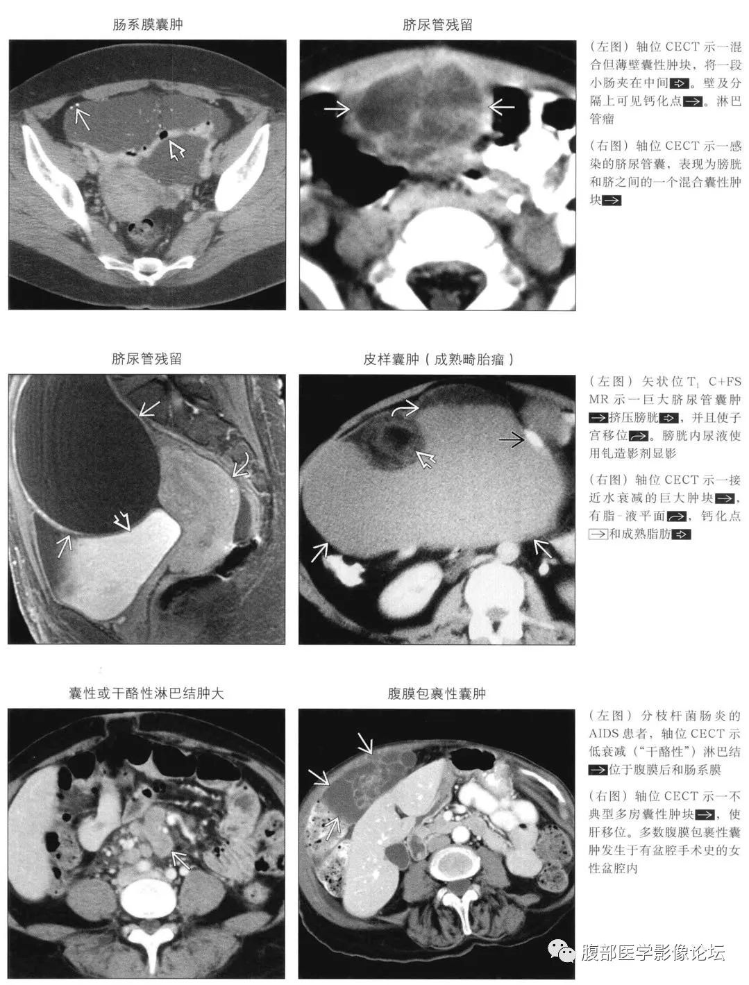 肠系膜或网膜囊性肿块疾病谱