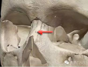 鼻骨解剖及鼻骨骨折