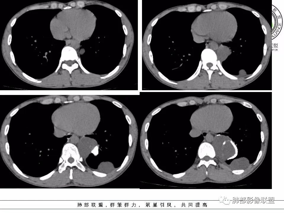 【病例】冬眠瘤一例影像讨论