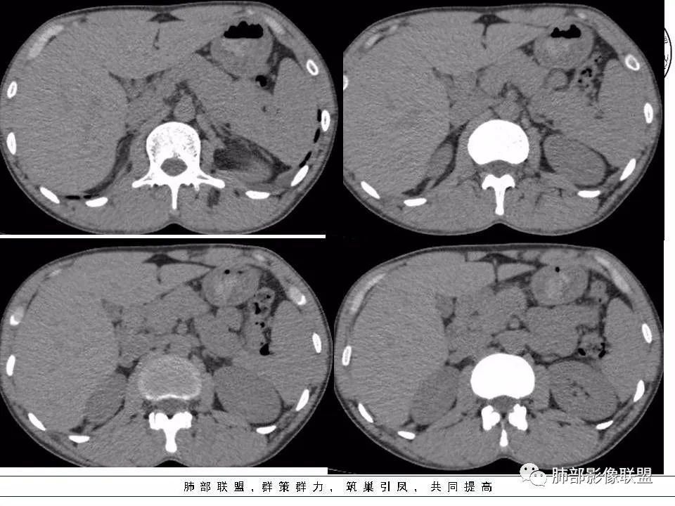 【病例】冬眠瘤一例影像讨论