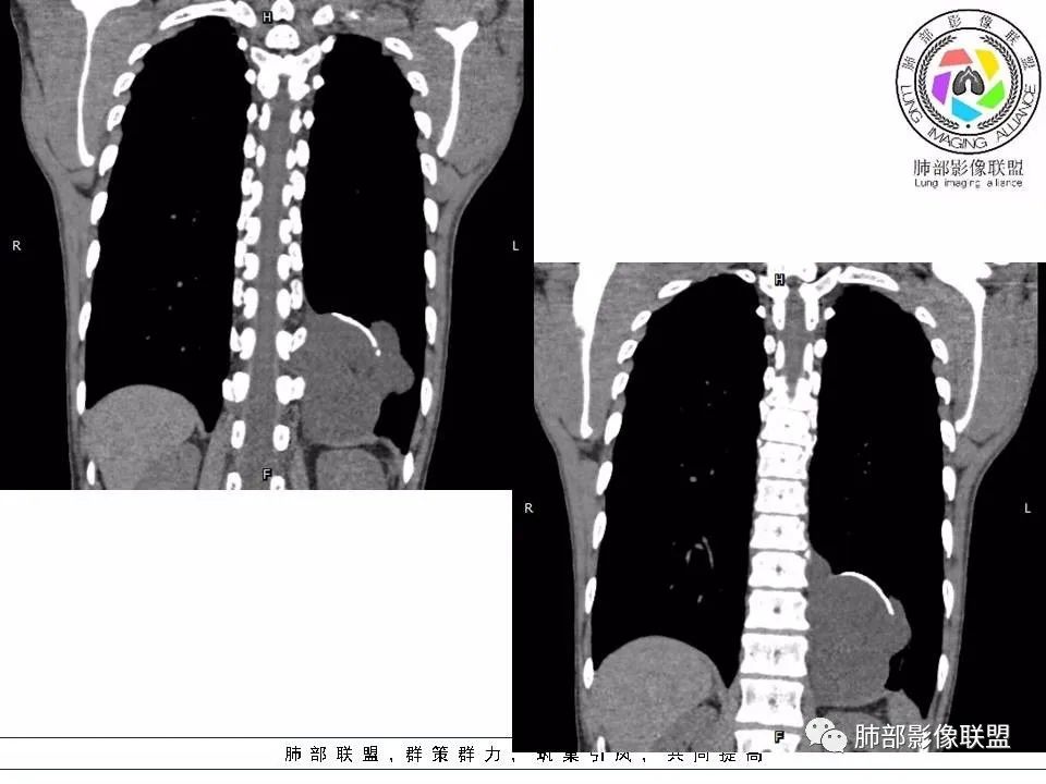 【病例】冬眠瘤一例影像讨论