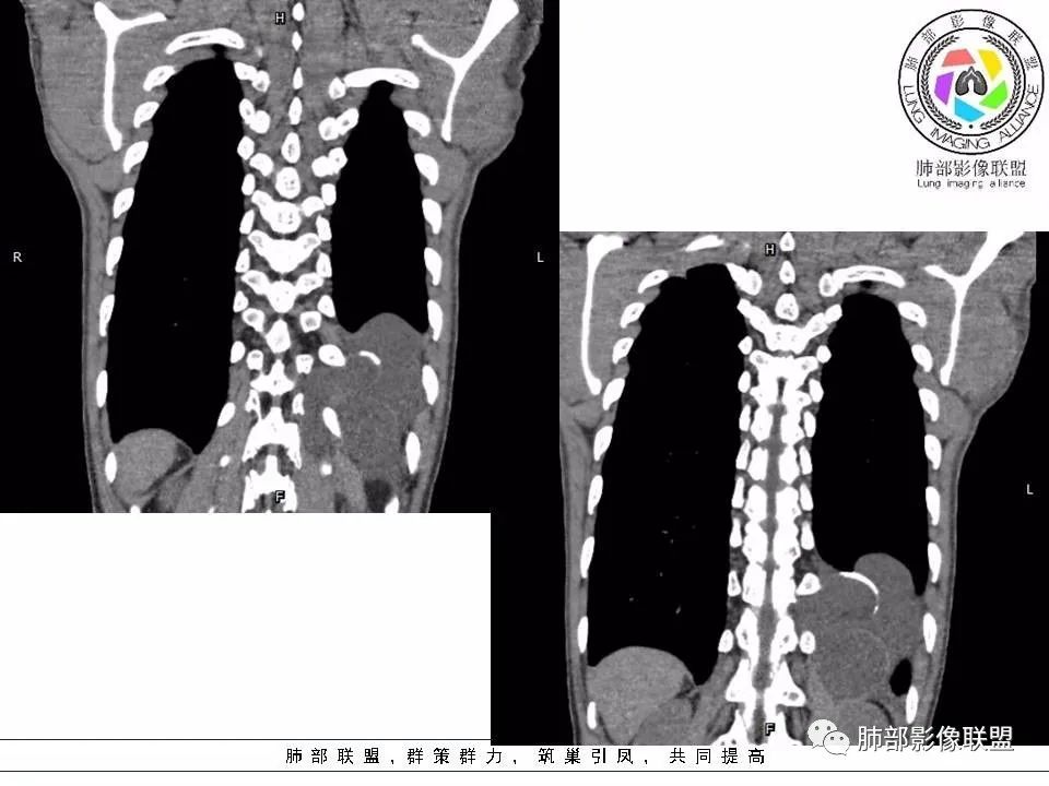【病例】冬眠瘤一例影像讨论