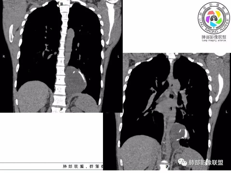 【病例】冬眠瘤一例影像讨论