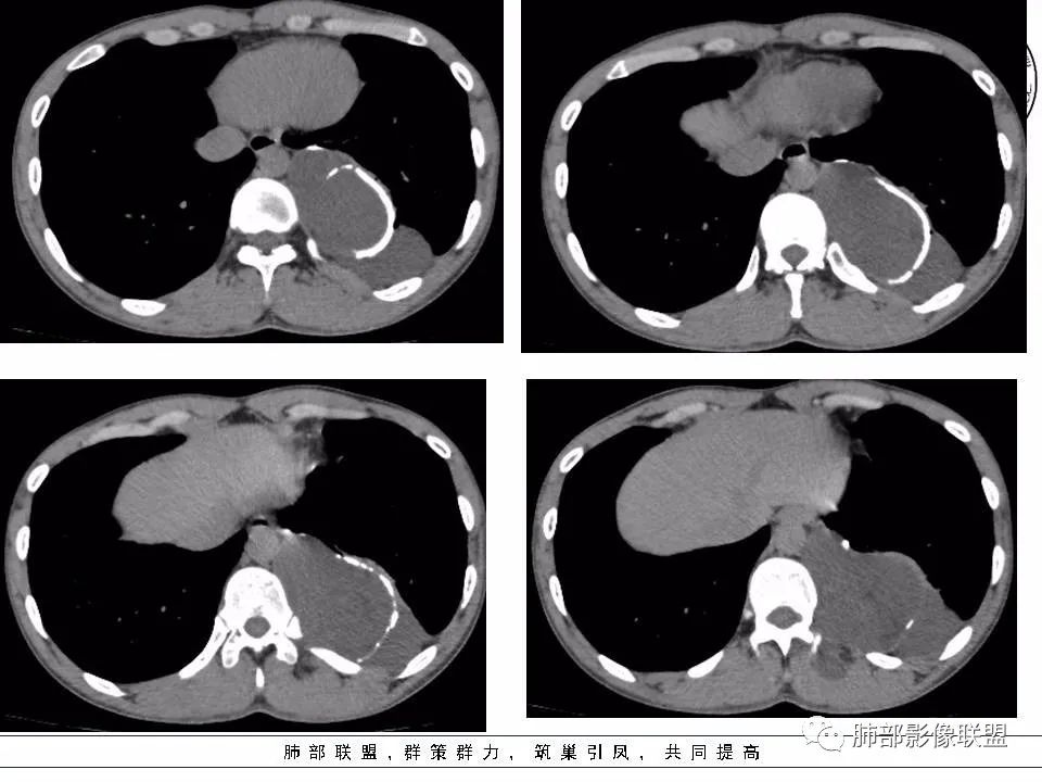【病例】冬眠瘤一例影像讨论