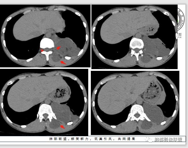 【病例】冬眠瘤一例影像讨论