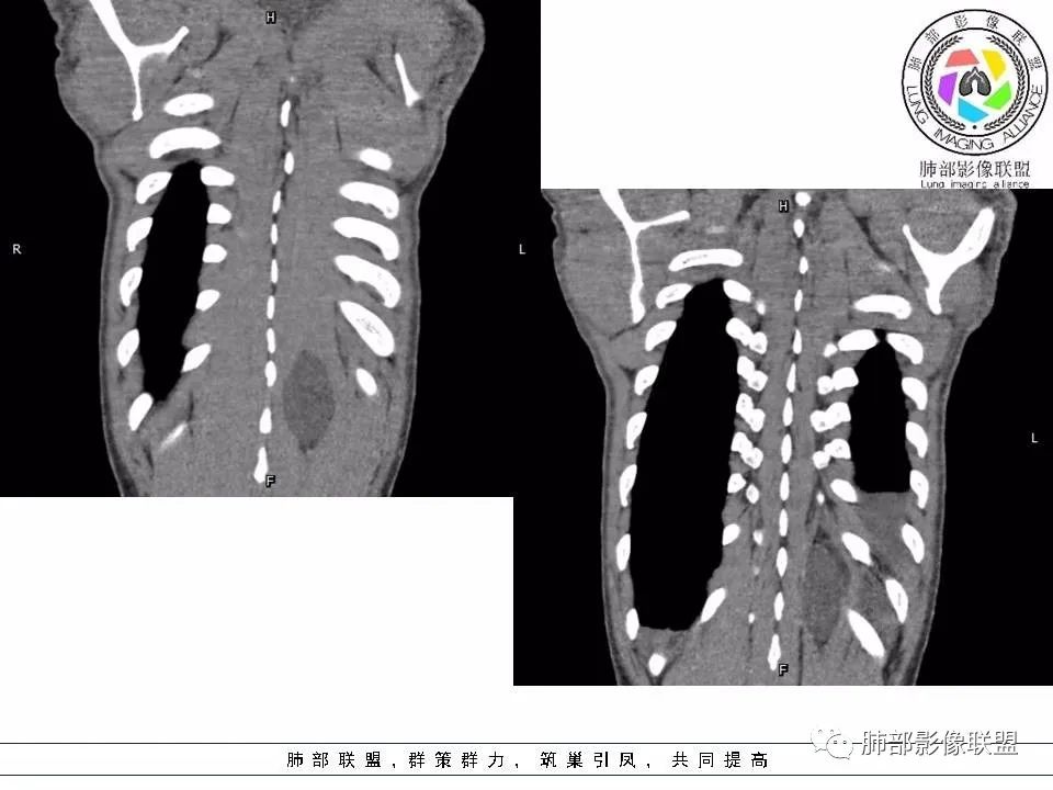 【病例】冬眠瘤一例影像讨论