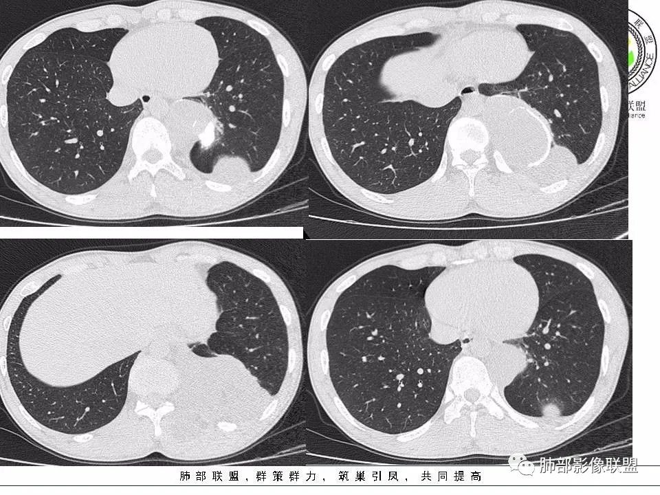 【病例】冬眠瘤一例影像讨论