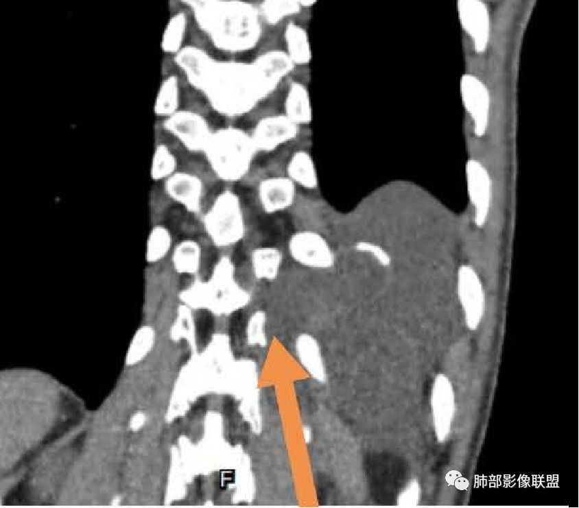 【病例】冬眠瘤一例影像讨论
