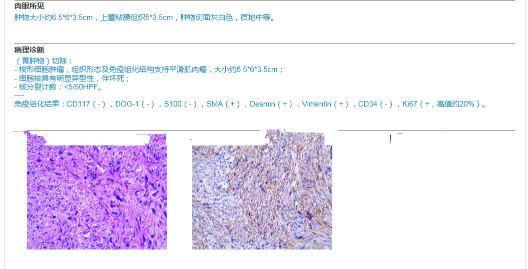 【病例】胃平滑肌肉瘤1例CT影像